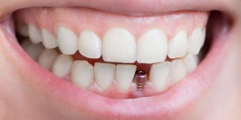 Giải mã ý nghĩa nằm mơ thấy rụng răng hàm dưới